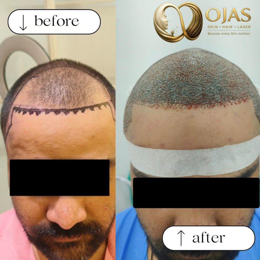 Hair transplant