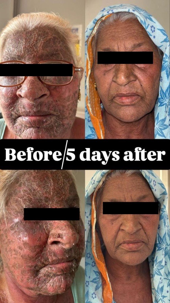Skin recovery